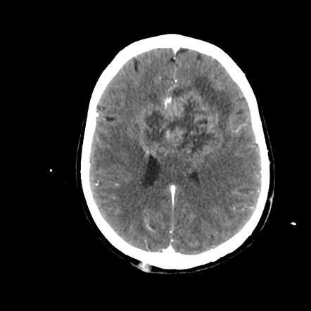 Glioblastoma NOS - butterfly appearance | Radiology Case | Radiopaedia.org