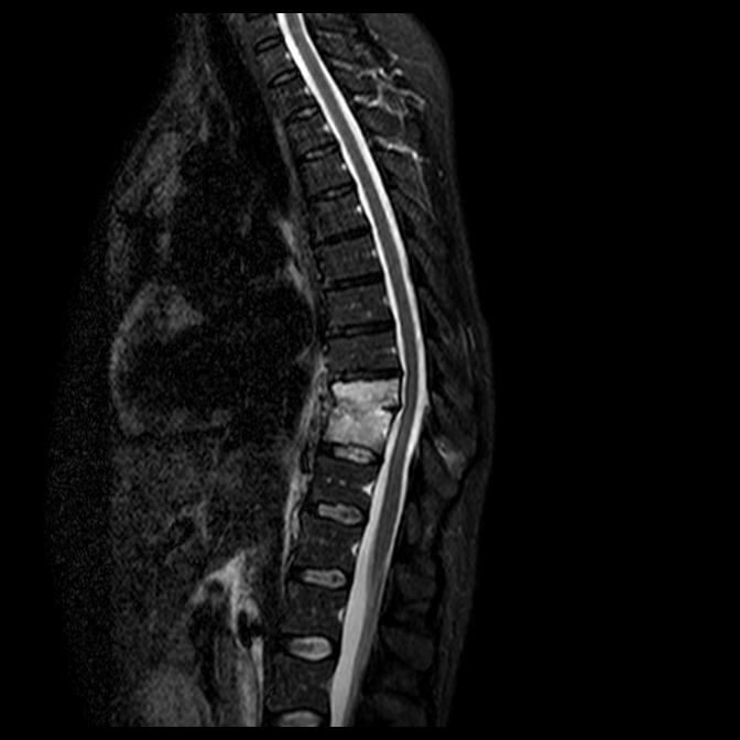 Spondylodiscitis With Pleural Empyema | Image | Radiopaedia.org