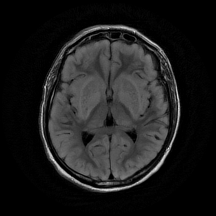 Uremic Encephalopathy | Image | Radiopaedia.org