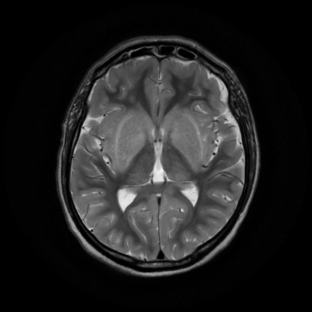 Uremic Encephalopathy | Image | Radiopaedia.org