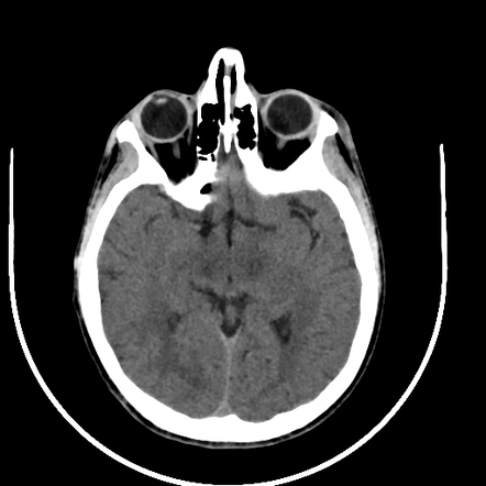 Wilson disease - CNS manifestations | Radiology Case | Radiopaedia.org