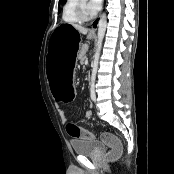 Ulcerative colitis with toxic megacolon | Image | Radiopaedia.org