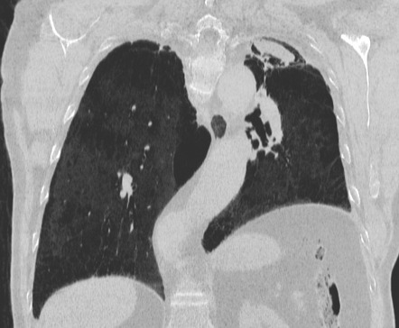 Aspergilloma 