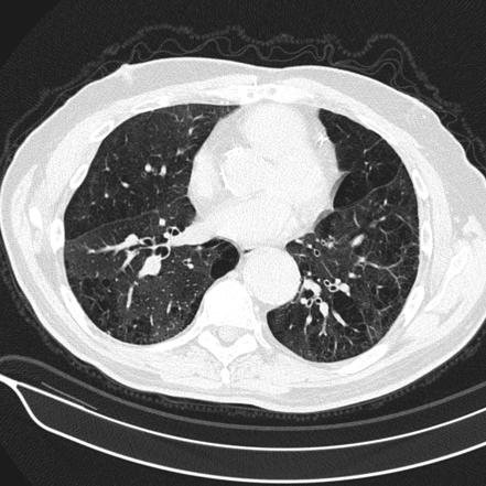 Aspergilloma | Radiology Reference Article | Radiopaedia.org