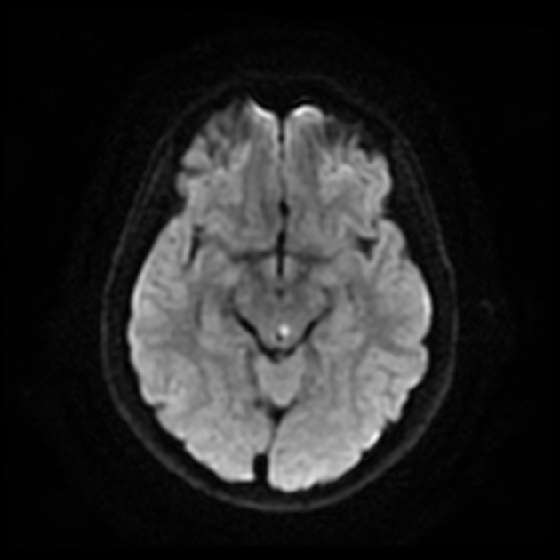 Oculomotor nerve palsy | Image | Radiopaedia.org