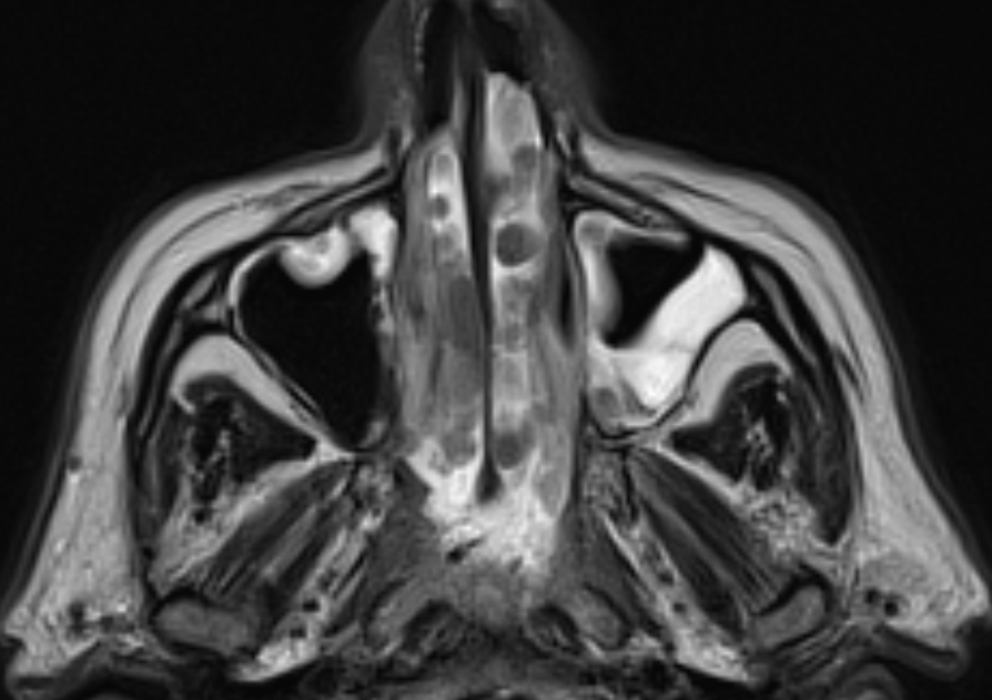 sinonasal-polyposis-image-radiopaedia