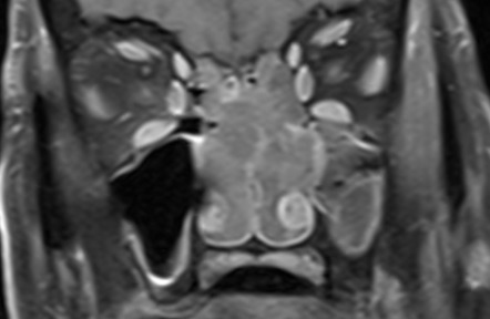 Sinonasal Polyposis Image Radiopaedia Org