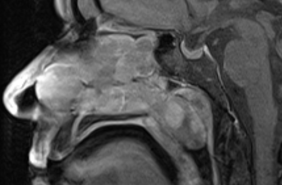 sinonasal-polyposis-image-radiopaedia