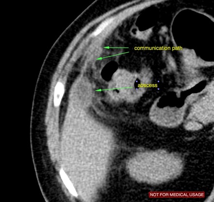 Acute Cholecystitis | Radiology Reference Article | Radiopaedia.org