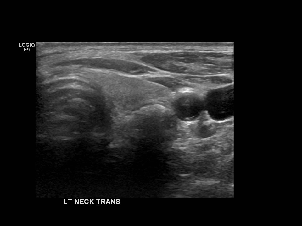 Paratracheal air cyst (ultrasound) | Image | Radiopaedia.org