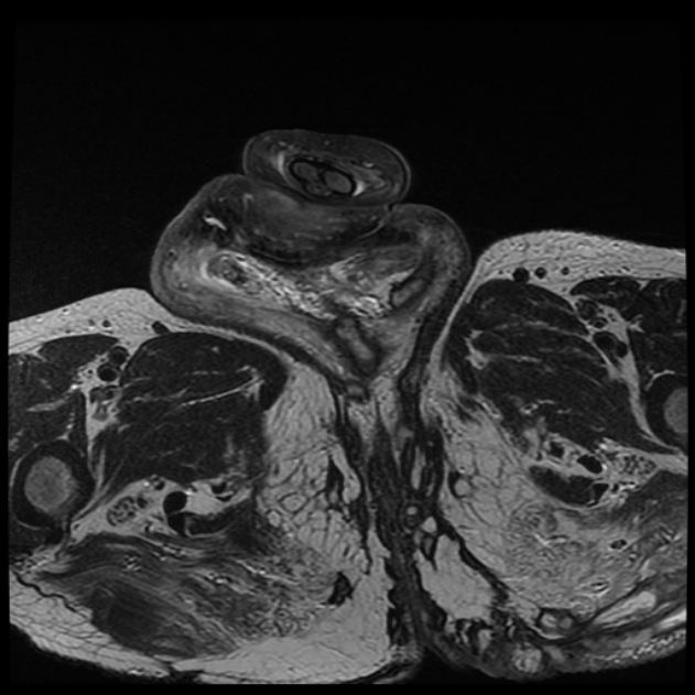 Hidradenitis Suppurativa | Image | Radiopaedia.org