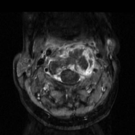 Tuberculosis - C2 | Image | Radiopaedia.org