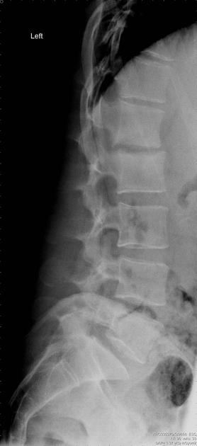 Spondylodiscitis | Radiology Reference Article | Radiopaedia.org