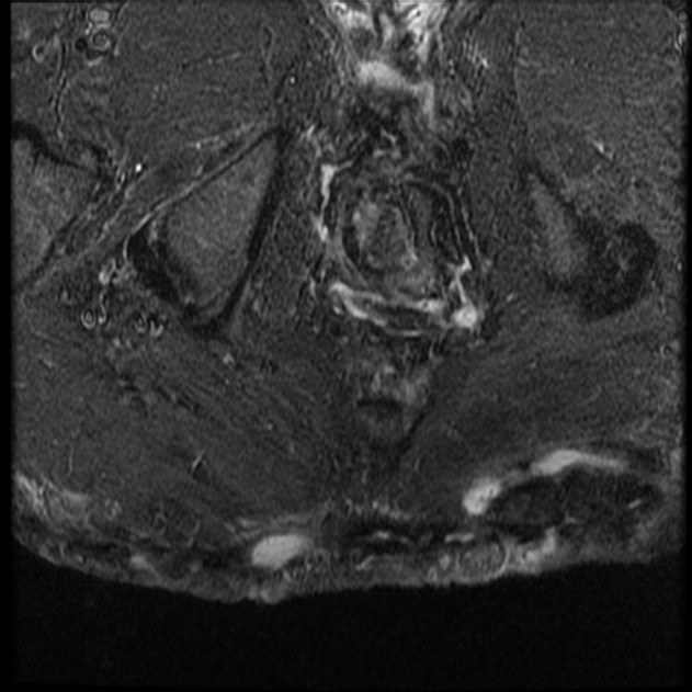 Hidradenitis Suppurativa | Image | Radiopaedia.org