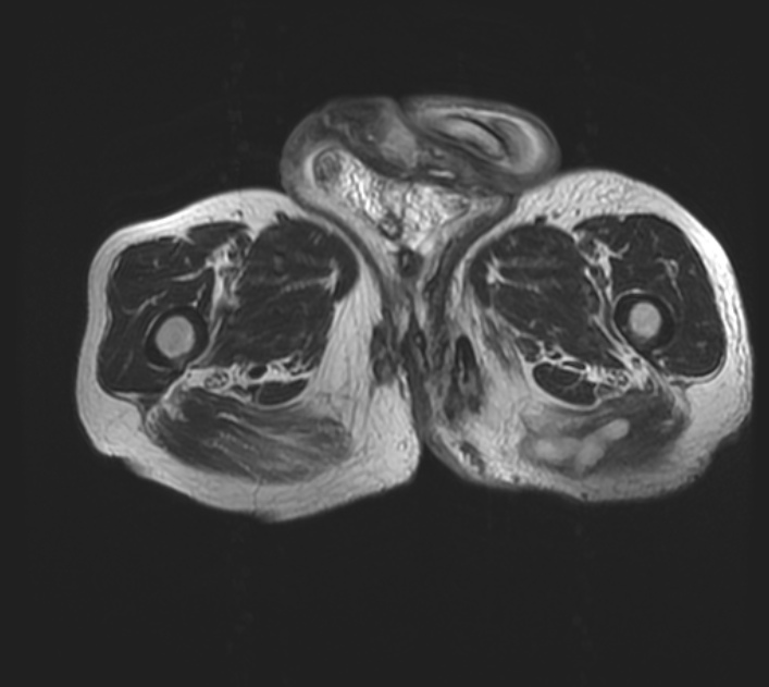 Hidradenitis suppurativa | Image | Radiopaedia.org