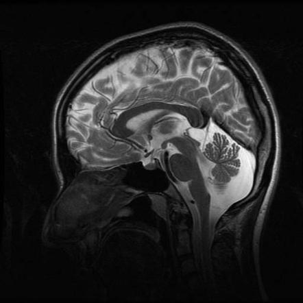 Pineal cyst | Radiology Case | Radiopaedia.org