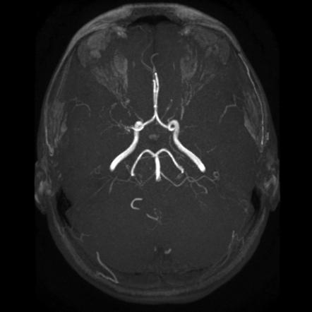 moyamoya disease radiology reference article radiopaedia org