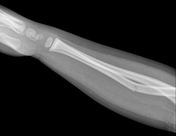 greenstick fracture distal radius