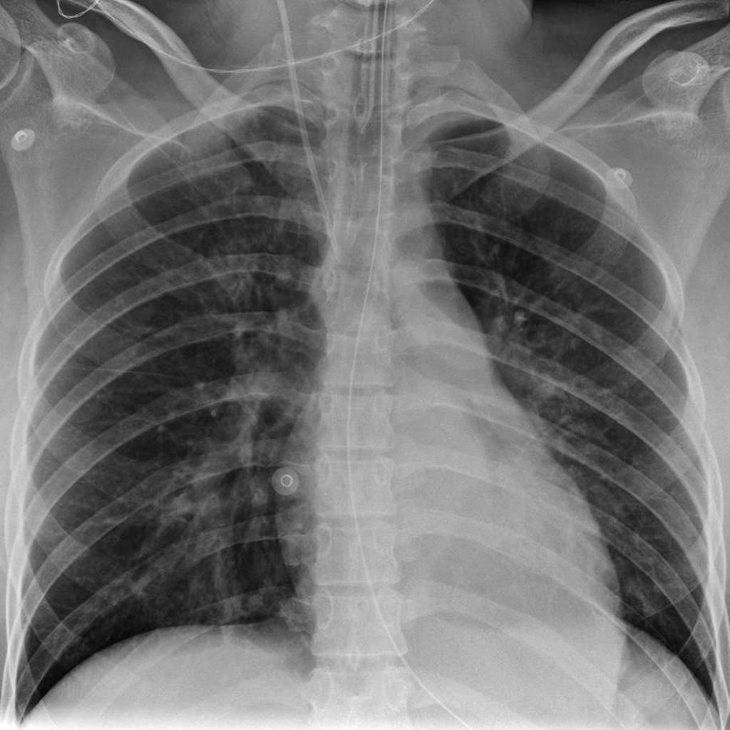 mucus-in-lungs-x-ray