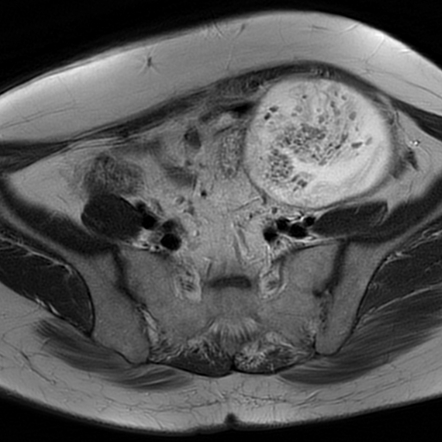 Intra-abdominal gossypiboma | Image | Radiopaedia.org