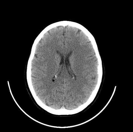 Choroid plexus lipoma | Radiology Case | Radiopaedia.org