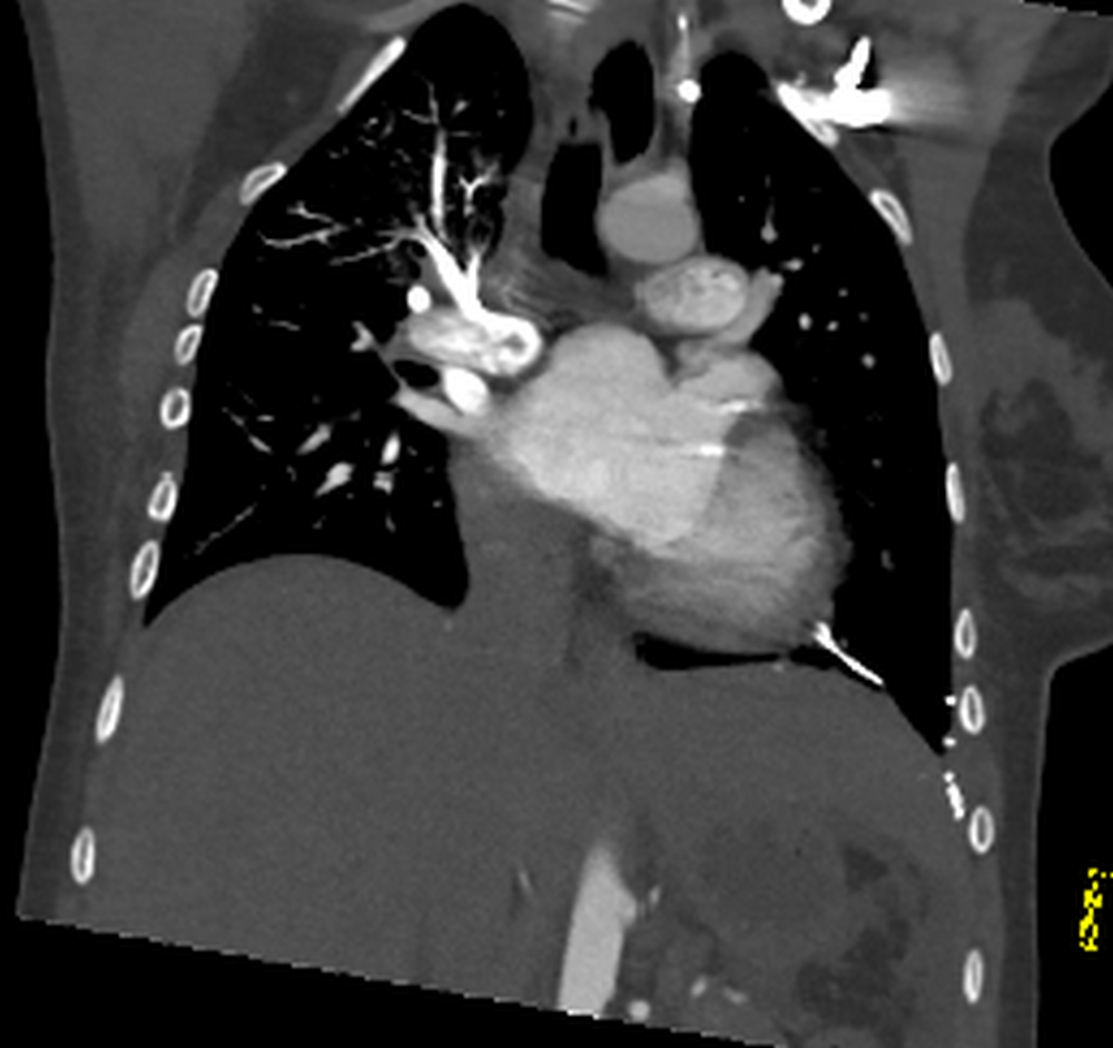 Modified Fontan procedure - venous admixture | Image | Radiopaedia.org