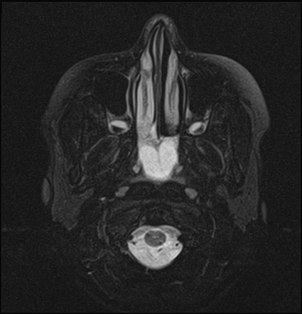 Spheno-choanal polyp | Image | Radiopaedia.org