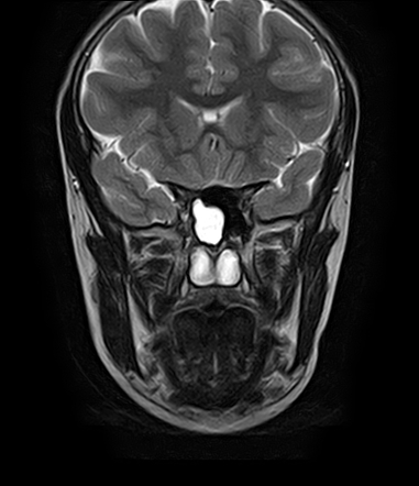 Spheno-choanal polyp | Image | Radiopaedia.org