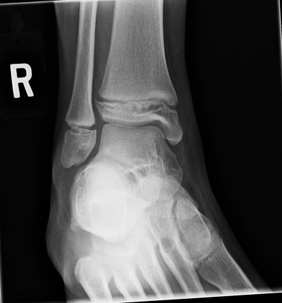 Distal tibial Salter-Harris II fracture | Radiology Case | Radiopaedia.org