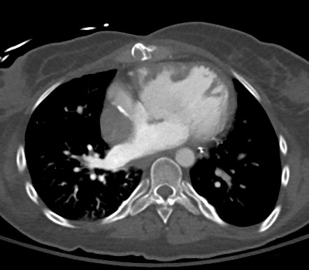 Modified Fontan procedure - venous admixture | Radiology Case ...