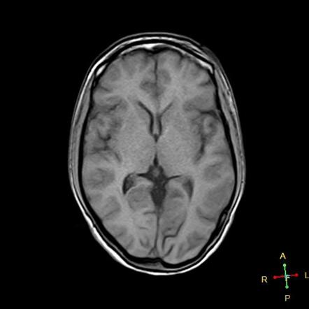 Multiple Sclerosis Image Radiopaedia Org