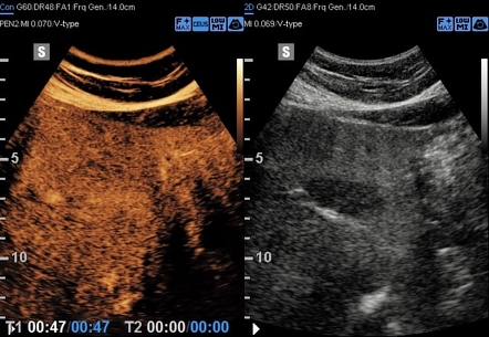 Focal fatty sparing of the liver (CEUS) | Radiology Case | Radiopaedia.org