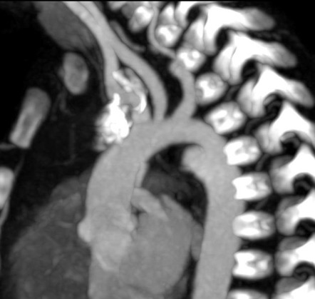 Aortic ductus diverticulum | Radiology Case | Radiopaedia.org