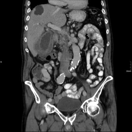 Acute Cholecystitis