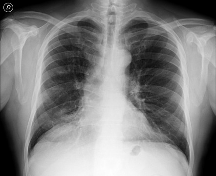 Middle lobe syndrome | Radiology Case | Radiopaedia.org