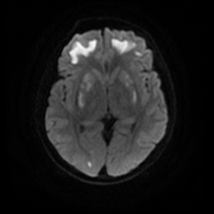 Acute methanol intoxication | Image | Radiopaedia.org