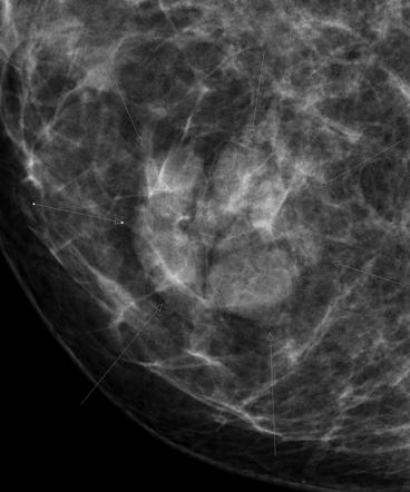 Breast nevus | Radiology Case | Radiopaedia.org