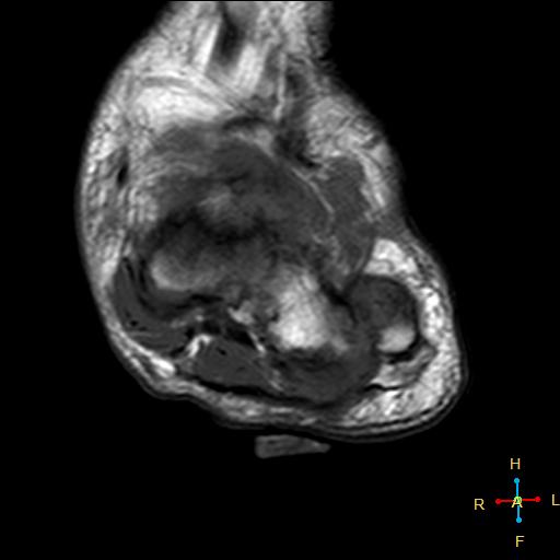 Diabetic foot | Image | Radiopaedia.org