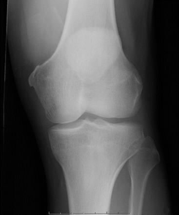 Pellegrini-Stieda lesion | Radiology Reference Article | Radiopaedia.org