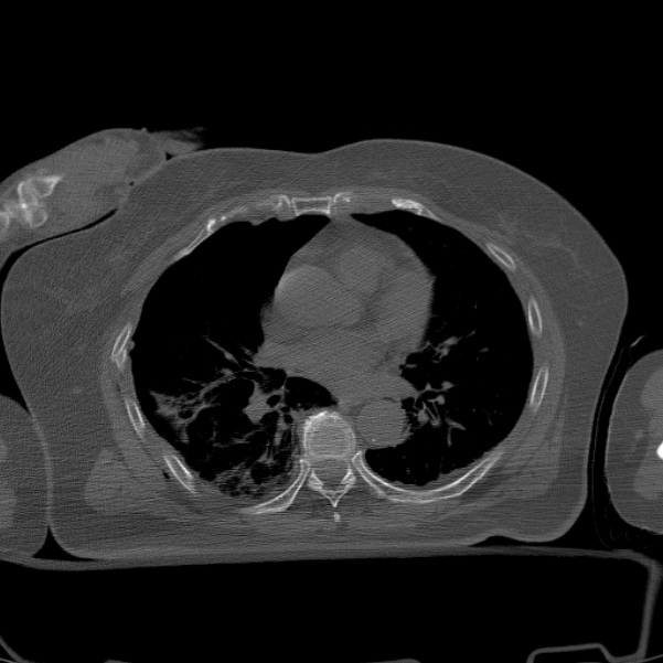 Traumatic pneumothorax Image