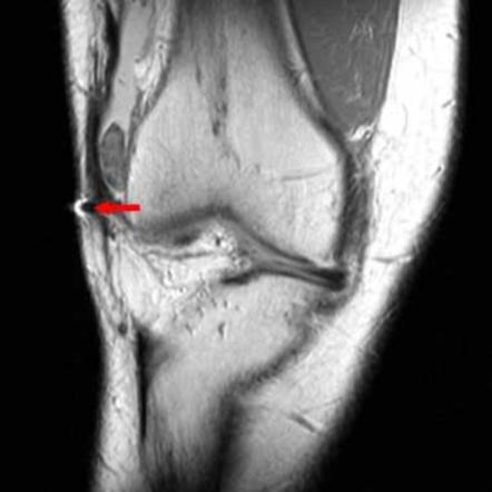 Pigmented villonodular synovitis | Image | Radiopaedia.org