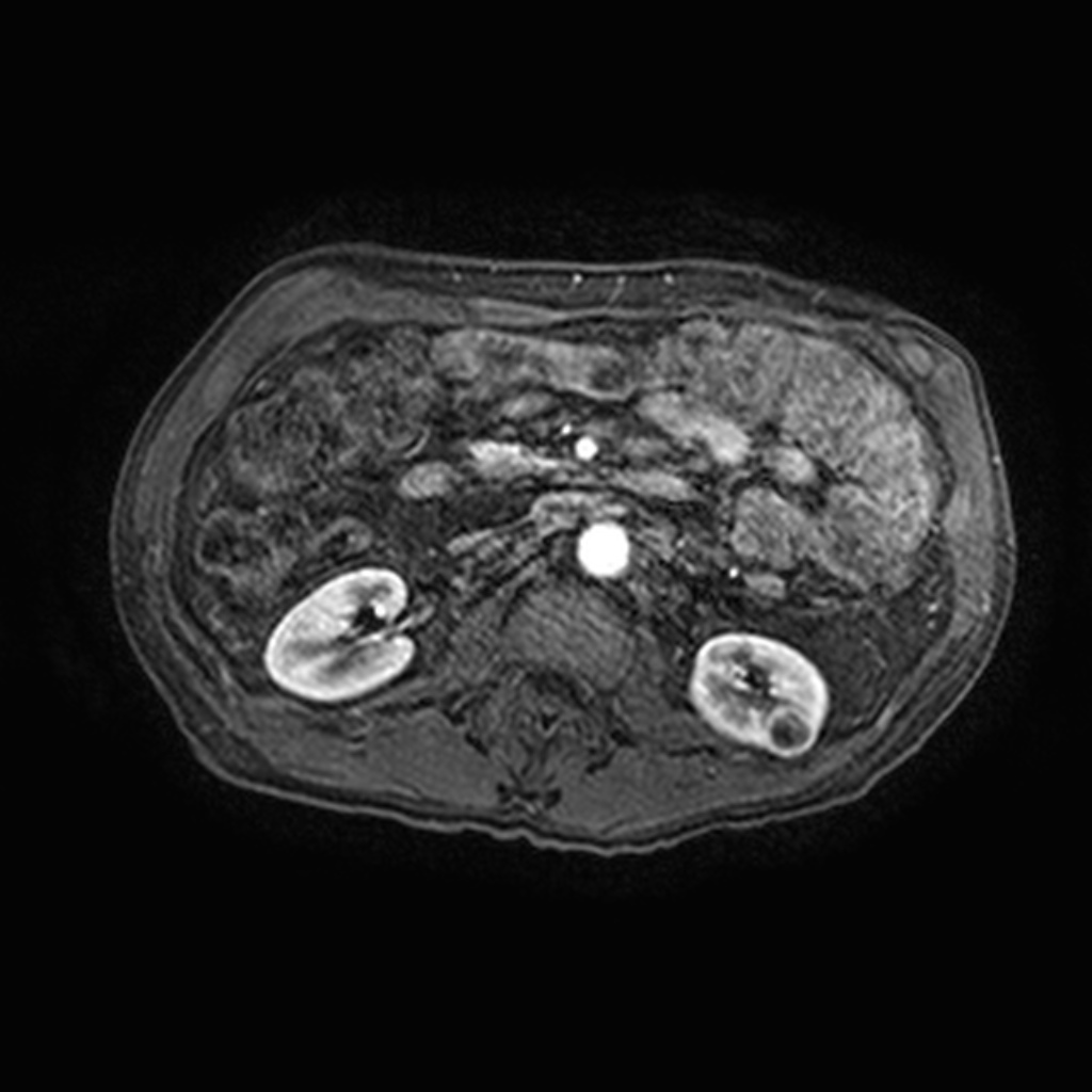 Renal oncocytoma | Image | Radiopaedia.org