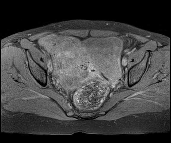 Pedunculated subserosal uterine leiomyoma | Image | Radiopaedia.org