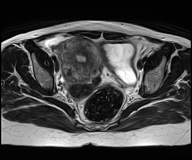 Pedunculated Subserosal Uterine Leiomyoma Image