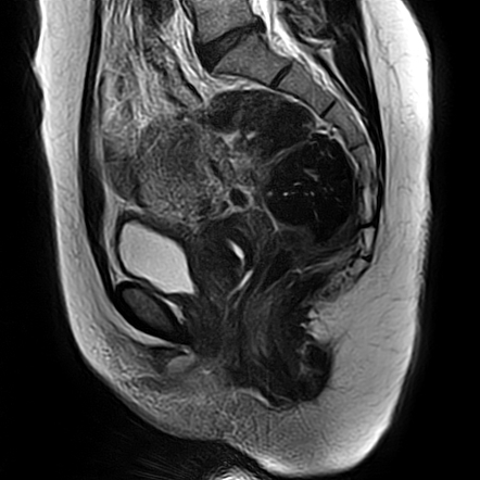 Pedunculated subserosal uterine leiomyoma | Image | Radiopaedia.org