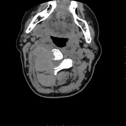 Cervical Spine Metastasis From Renal Cell Carcinoma | Image ...