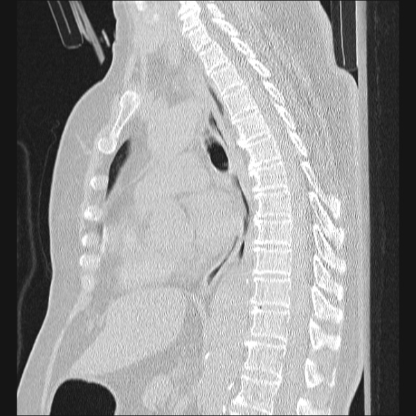 Traumatic pneumothorax Image