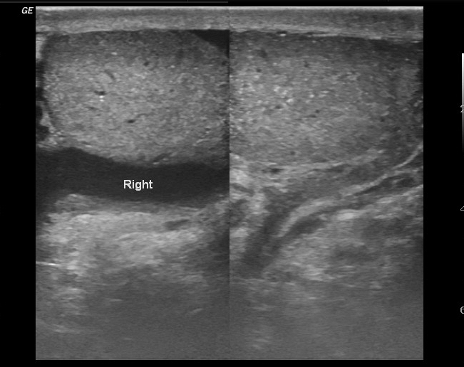 Testicular Microlithiasis Image