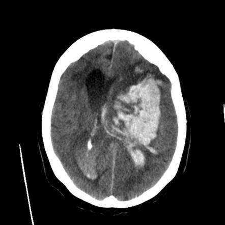 Intracerebral Hemorrhage | Radiology Reference Article | Radiopaedia.org