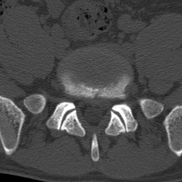 Lumbar Central Focal Disc Protrusion Image